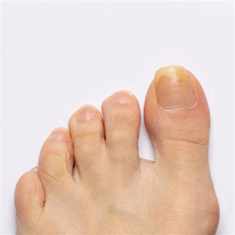 How To Treat Yellow Brittle Toenails Tutorial Pics