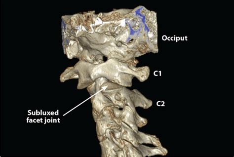 Ct Scan Shows Subluxation Of The Facet Joint At C1 C2 Injury To The
