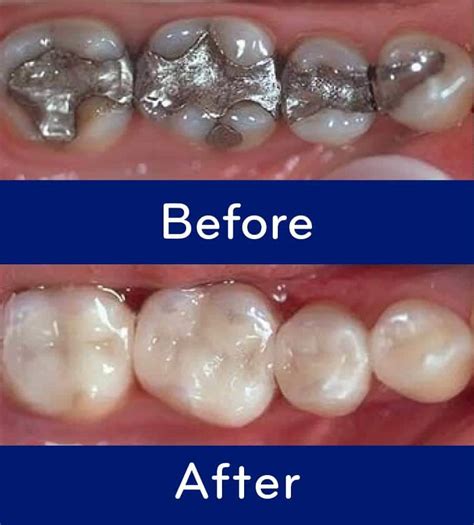 Silver (mercury) fillings turn your teeth black over time. Ozone treatment for Cavities in Rockville