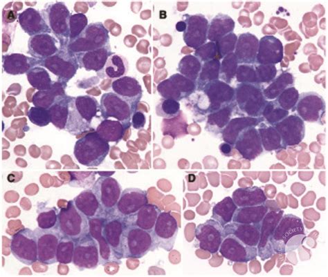 There are more than 30 different treatments for ctcl, and new treatments are quickly becoming available. Hepatosplenic T-cell lymphoma mimicking bone marrow metastasis