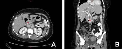 (A) CT scan -axial view at the time of diagnosis and after ...