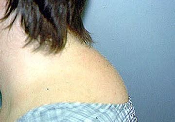 This disorder (called kyphosis or a dowager's hump) is an exaggeration of your spine, that causes the shoulders to slump forward and the top of your back to look enlarged and humped. Cushing's with Moxie: Fighting The Worst Disease You've ...
