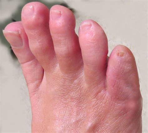 West Vancouver Foot Clinic Hammertoe And Bunion Surgical Procedures