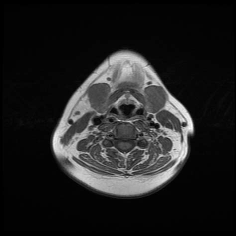 Chronic Submandibular Sialadenitis Radiology Case