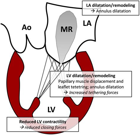 Mitral Valve Interventions In Heart Failure Lavall 2018 Esc Heart