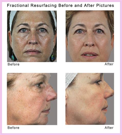 Erbium Fractional Laser Skin Resurfacing Beautyworks
