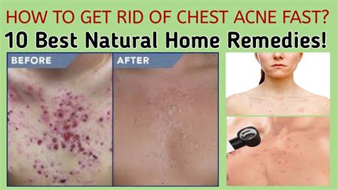 How To Get Rid Of Chest Acne Fast 10 Best Natural Home Remedies Acne