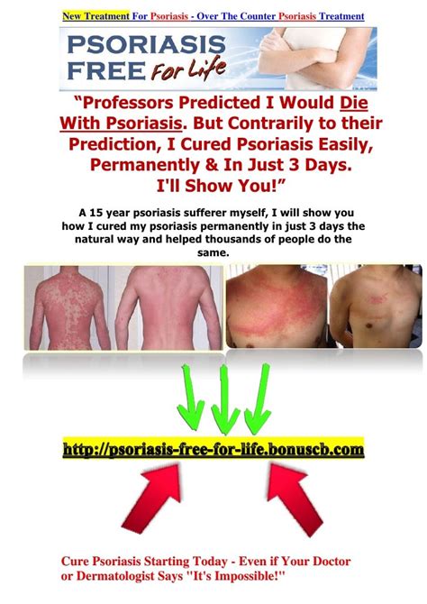 Natural Psoriasis Treatment New Treatment For Psoriasis