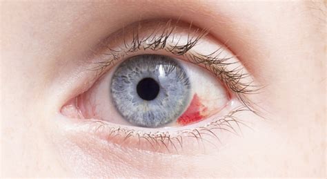 What A Broken Blood Vessel Means For Your Eye Ophthalmologist In