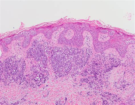 Merkel cell carcinoma (mcc) is a rare and aggressive skin cancer occurring in about 3 people per 1,000,000 members of the population. Pathology Outlines - Merkel cell carcinoma