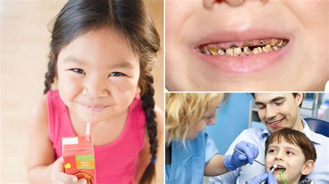 Half Of Children Have Tooth Decay With Poverty And Sugar Blamed For