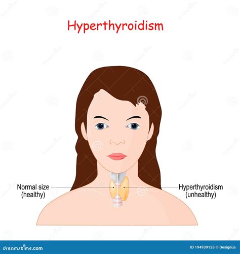 甲亢 甲状腺腺的妇女 向量例证 插画 包括有 传记 系统 比较 市场活动 疾病 健康 脖子 194939128