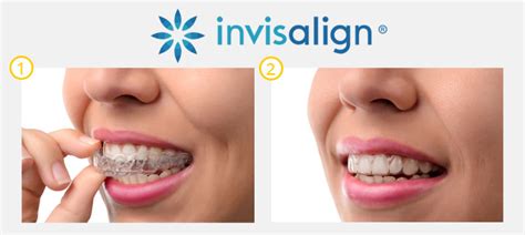 A set of invisalign trays runs between $3,000 and $5,000. Invisalign Provider Bonita Springs - Clear Braces - SMILE ...
