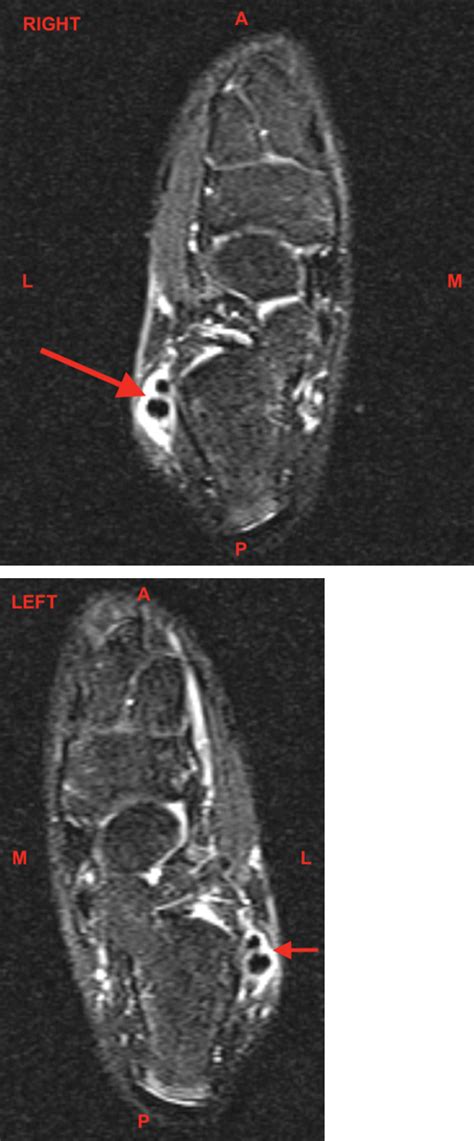 Bilateral Peroneal Tendon Subluxation Of An Adolescent Female With Mri
