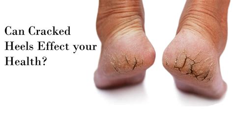 5 Guaranteed Remedies To Cure Cracked Dry Feet Marham