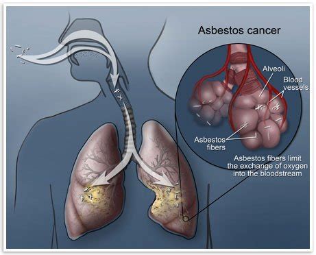 Mesothelioma.com is dedicated to providing the latest medical information on mesothelioma, spreading awareness about the dangers of asbestos exposure and providing victims with free resources. Mesothelioma