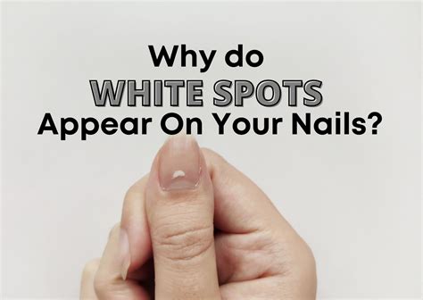 7 Causes Of White Spots On Nails
