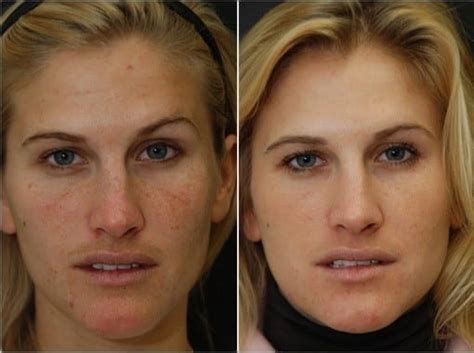 Vi Peels Before And After Photo Gallery Dr Dean Kane