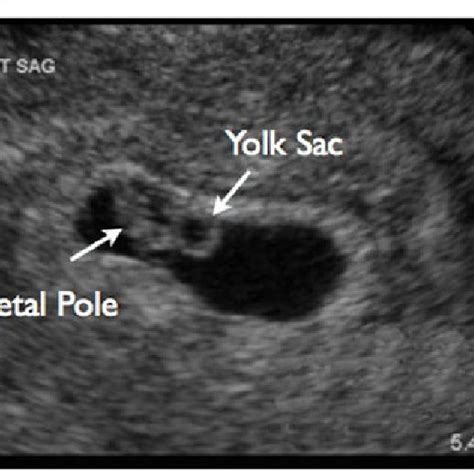 Trans Abdominal Ultrasound Image Showing Measurement Of Gestational Sac