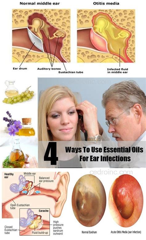 Home Remedies For Ear Infection Ear Infection Remedy Ear Infection