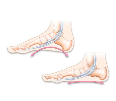 Flat Foot Feet Fallen Arches Treatment Center Florida Foot And Ankle