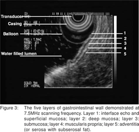 Upper Gastrointestinal Submucosal Lesions Clinical And Endosonographic Evaluation And Management