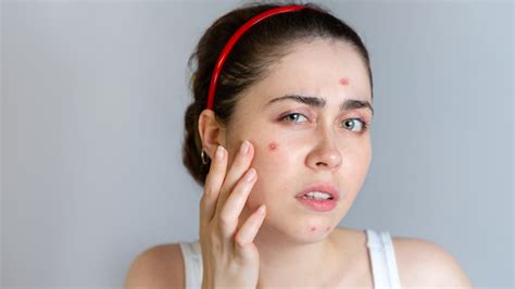 How To Treat Acne Upstate Physicians