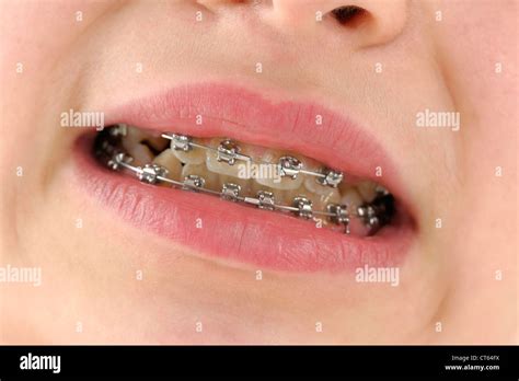 Close Up Dental Brace Hi Res Stock Photography And Images Alamy