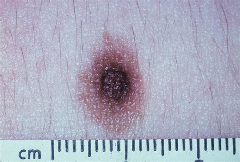 Dysplastic Nevus Part I Historical Perspective Classification And