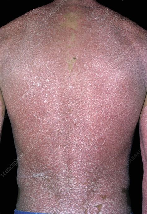 Erythrodermic Psoriasis Stock Image C0517450 Science Photo Library