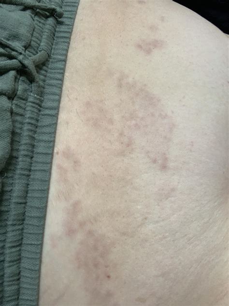 Purple Rash On Lower Stomach For A Month Rdermatologyquestions