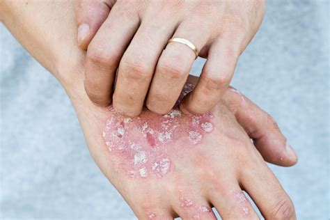 Plaques Flat And Raised Skin Changes In Plaque Psoriasis