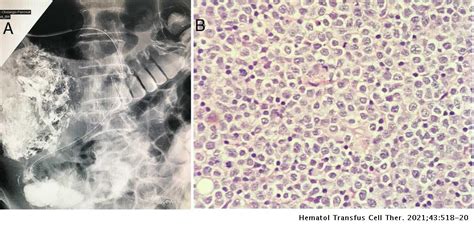 Monomorphic Epitheliotropic Intestinal T Cell Lymphoma Of The Duodenum