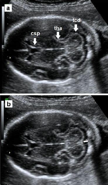 Image Result For Cerebellar And Cisterna Magna On Ultrasound