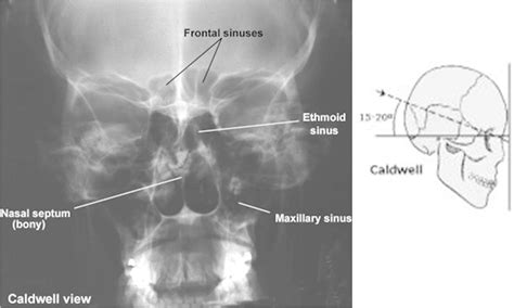 facial caldwell fractures trauma emergencies ent em1 recap studyblue