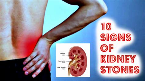 10 Signs Of Kidney Stones Youtube