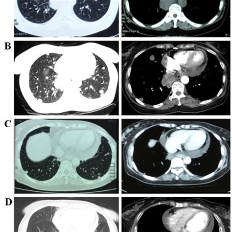 Chest Computed Tomography Ct Scans Before The First Chemotherapy