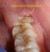 Pictures of Insurance Cover Wisdom Teeth