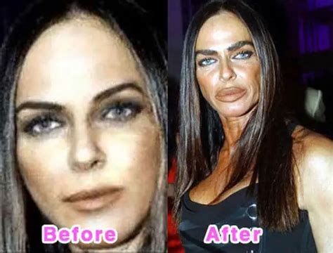 Celebrity Plastic Surgery Disasters Before And After