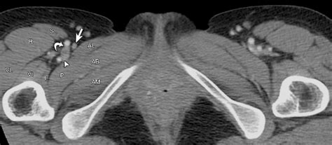Pelvic Lymph Nodes Anatomy Ct Human Anatomy Images And Photos Finder