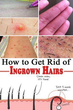 And once the follicle is dead, you won't have to worry about any nasty little ingrown hairs popping up again. How to Get Rid of Ingrown Hairs #UnderEyesRemedies # ...