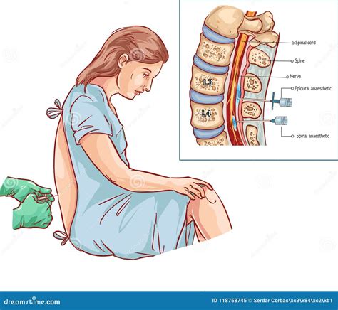 Epidural Nerve Block Injection Illustration Stock Vector Illustration