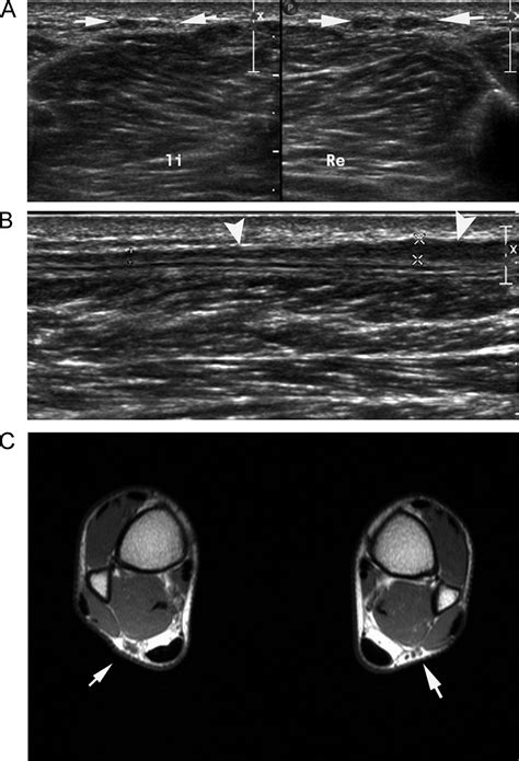 Ultrasound Of The Sural Nerve Normal Anatomy On Cadaveric Dissection