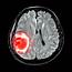 Brain Tumor Symptoms Not Just In Your Head  University Health News