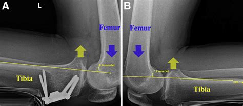 Anterolateral Biplanar Proximal Tibial Opening Wedge Osteotomy