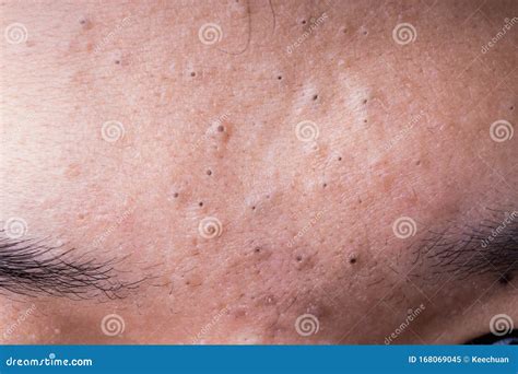Ugly Pimples Blackheads On Forehead Of Teenager Stock Image Image Of