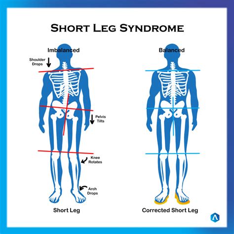 Short Leg Syndrome Dr Abbie Clinics
