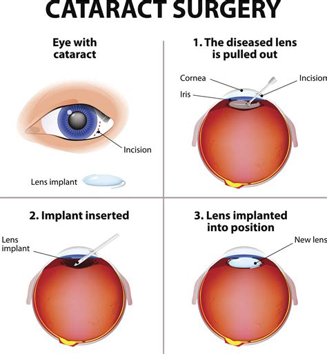 What Is Cataract Surgery Cataract Surgery Is A Procedure To Remove The Lens Of Your Eye And