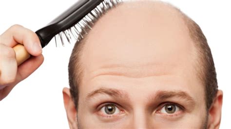 What Causes Baldness Mental Floss
