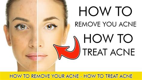 How To Remove Your Acne How To Treat Acne Loan Nguyen Acne